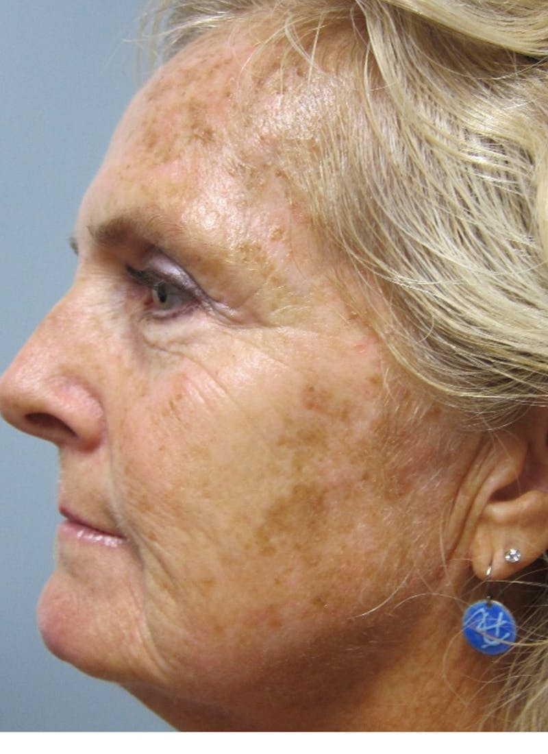 Red/Brown Spot Removal Before & After Gallery - Patient 103156 - Image 1
