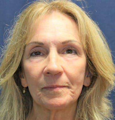 Skin Rejuvenation Before & After Gallery - Patient 153418 - Image 2