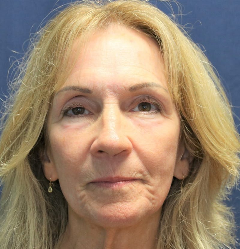 Skin Rejuvenation Before & After Gallery - Patient 153418 - Image 2