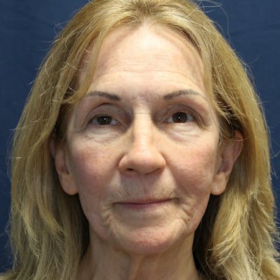 Skin Rejuvenation Before & After Gallery - Patient 153418 - Image 1