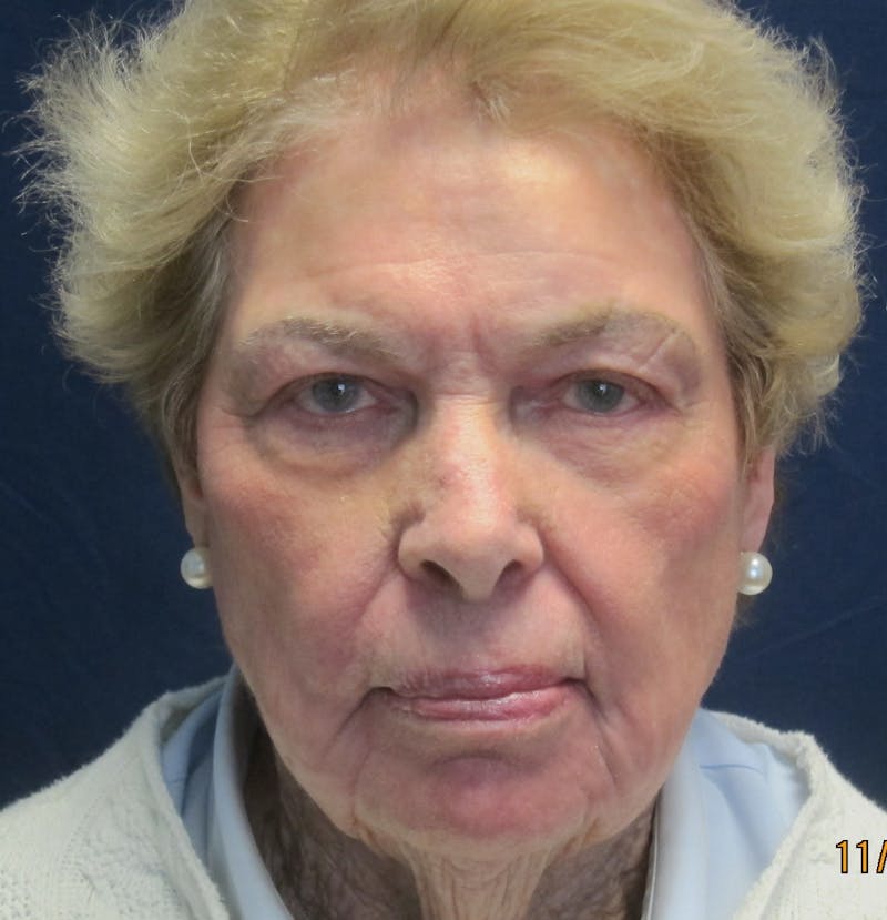 Skin Rejuvenation Before & After Gallery - Patient 170665 - Image 2