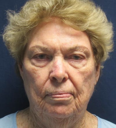 Skin Rejuvenation Before & After Gallery - Patient 170665 - Image 1