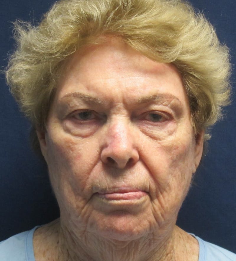 Skin Rejuvenation Before & After Gallery - Patient 170665 - Image 1