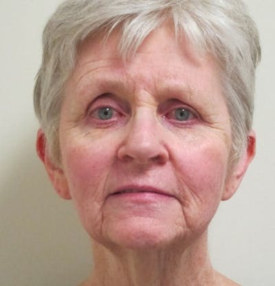 Skin Rejuvenation Before & After Gallery - Patient 335478 - Image 2
