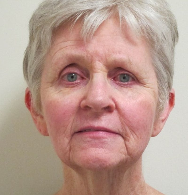 Skin Rejuvenation Before & After Gallery - Patient 335478 - Image 2