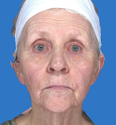 Skin Rejuvenation Before & After Gallery - Patient 335478 - Image 1