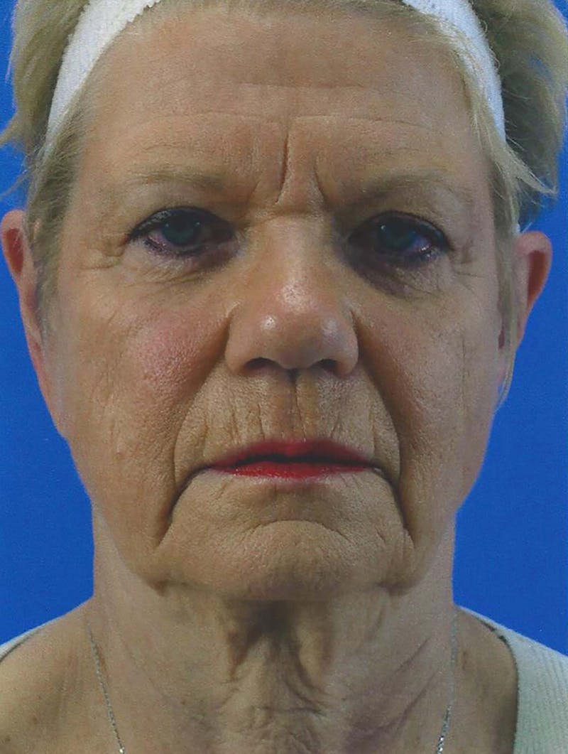 Facelift Before & After Gallery - Patient 151707 - Image 1