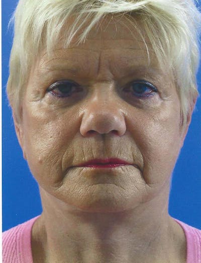 Facelift Before & After Gallery - Patient 151707 - Image 2