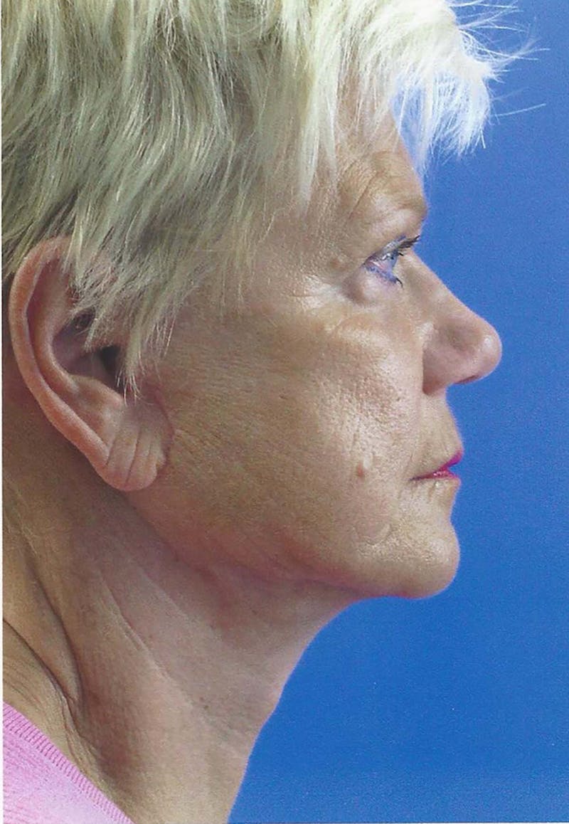 Facelift Before & After Gallery - Patient 151707 - Image 3