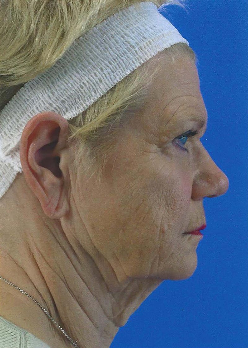 Facelift Before & After Gallery - Patient 151707 - Image 4