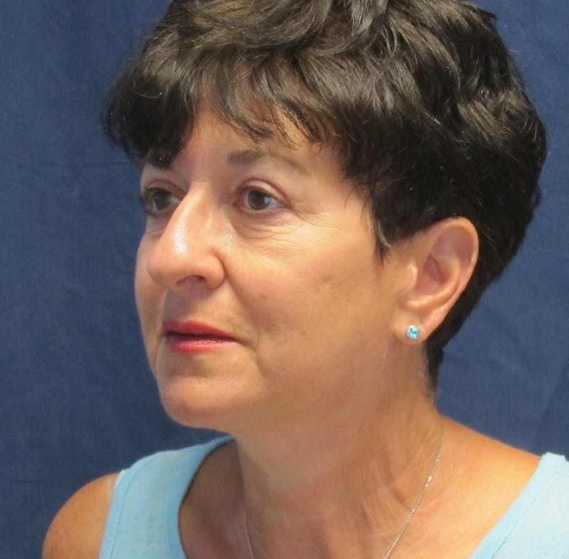 Facelift Before & After Gallery - Patient 988236 - Image 4