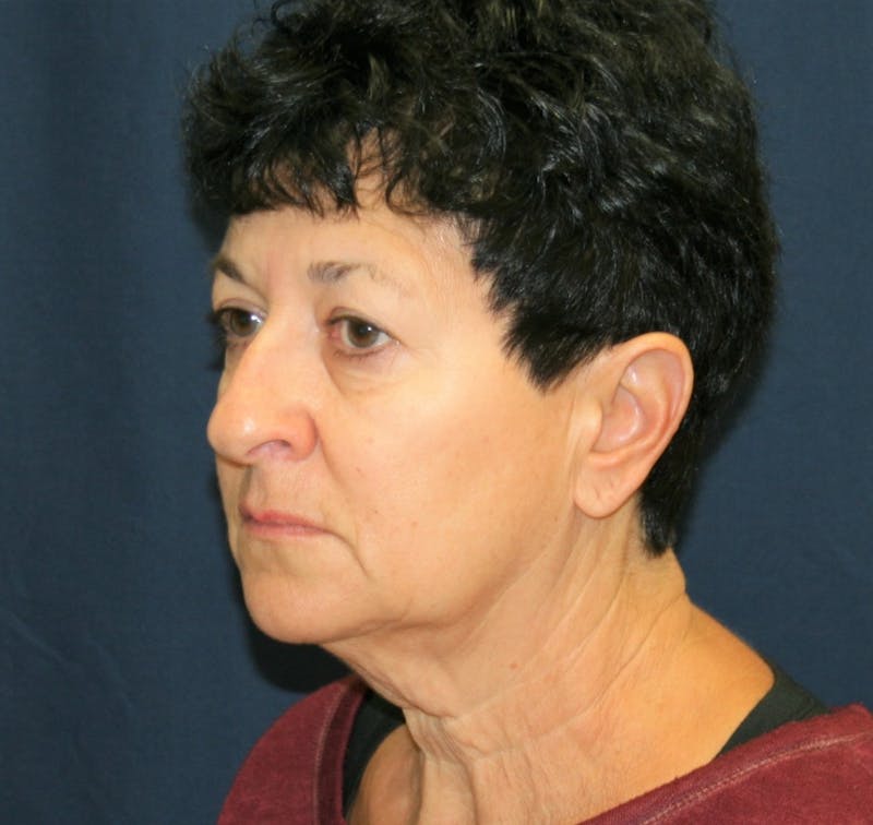 Facelift Before & After Gallery - Patient 988236 - Image 3