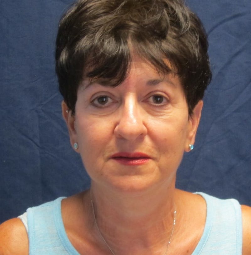 Facelift Before & After Gallery - Patient 988236 - Image 2