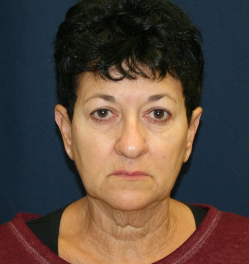 Facelift Before & After Gallery - Patient 988236 - Image 1