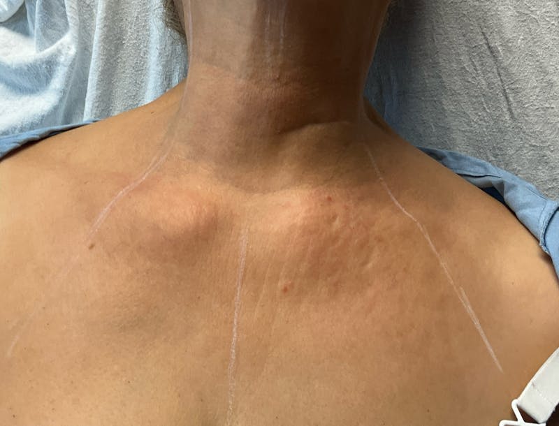Red/Brown Spot Removal Before & After Gallery - Patient 835048 - Image 2