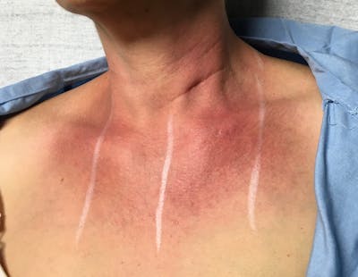 Red/Brown Spot Removal Before & After Gallery - Patient 835048 - Image 1