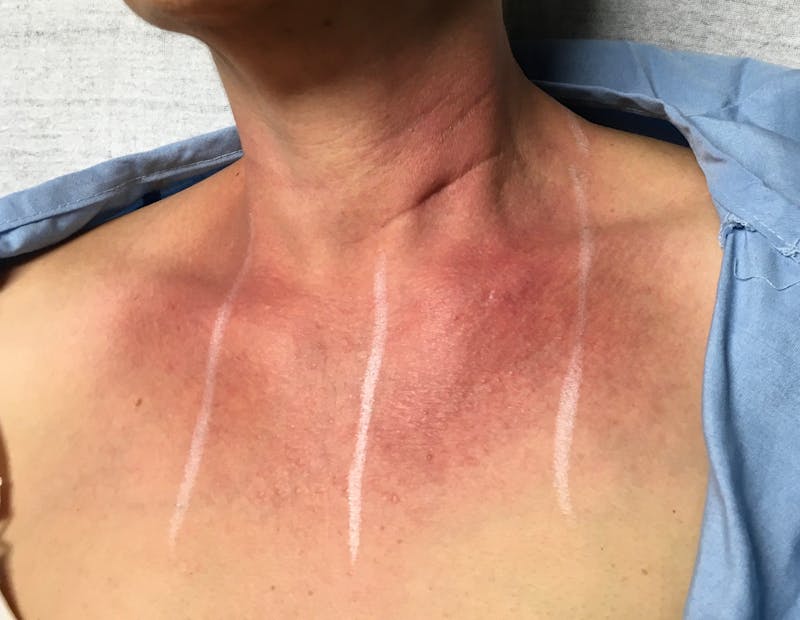 Red/Brown Spot Removal Before & After Gallery - Patient 835048 - Image 1