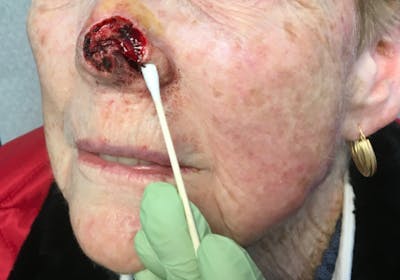 Face Reconstructive Before & After Gallery - Patient 326327 - Image 1