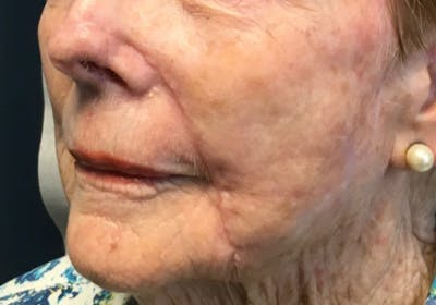 Face Reconstructive Before & After Gallery - Patient 326327 - Image 2