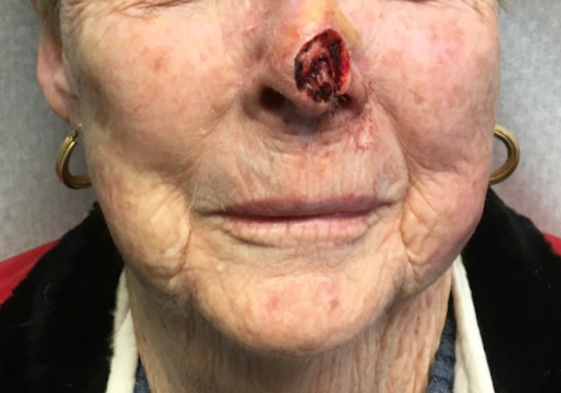 Face Reconstructive Before & After Gallery - Patient 326327 - Image 3