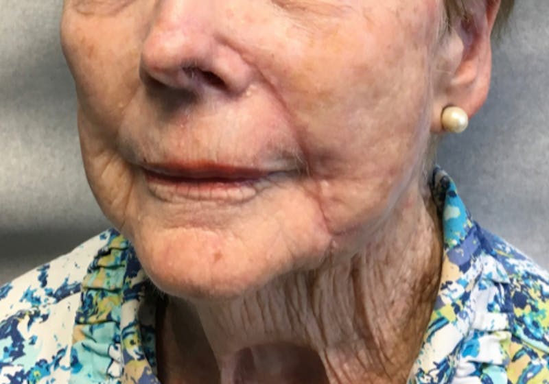 Face Reconstructive Before & After Gallery - Patient 326327 - Image 4