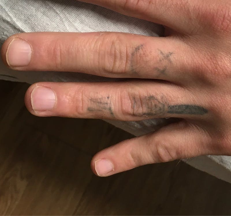 Tattoo Removal Before & After Gallery - Patient 286068 - Image 1