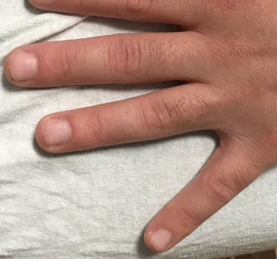 Tattoo Removal Before & After Gallery - Patient 286068 - Image 2