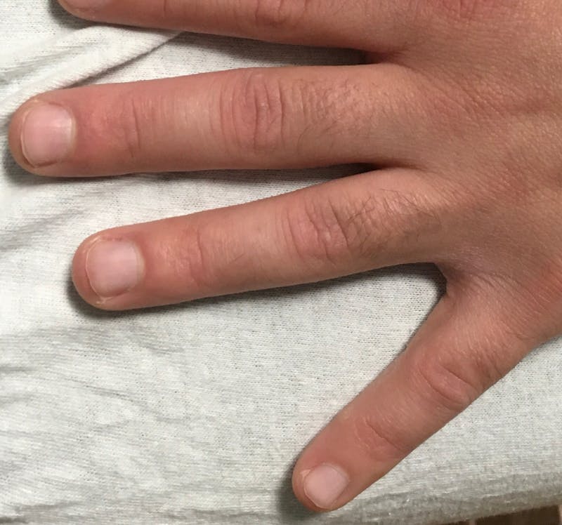 Tattoo Removal Before & After Gallery - Patient 286068 - Image 2