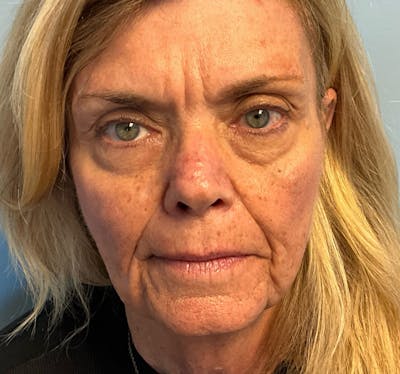 Face Reconstructive Before & After Gallery - Patient 438718 - Image 2