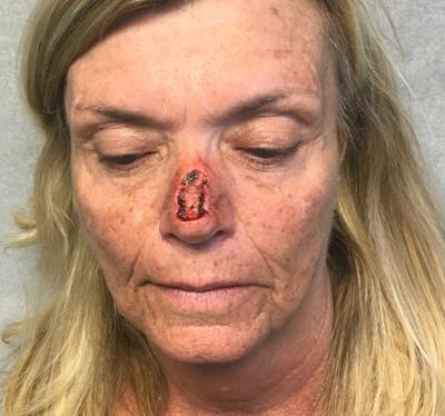 Face Reconstructive Before & After Gallery - Patient 438718 - Image 1