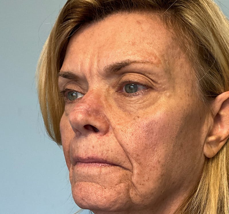 Face Reconstructive Before & After Gallery - Patient 438718 - Image 4