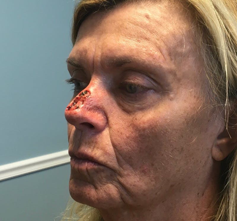 Face Reconstructive Before & After Gallery - Patient 438718 - Image 3