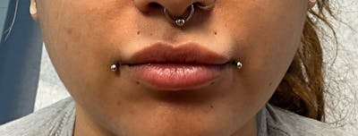 Fillers Before & After Gallery - Patient 369109 - Image 1