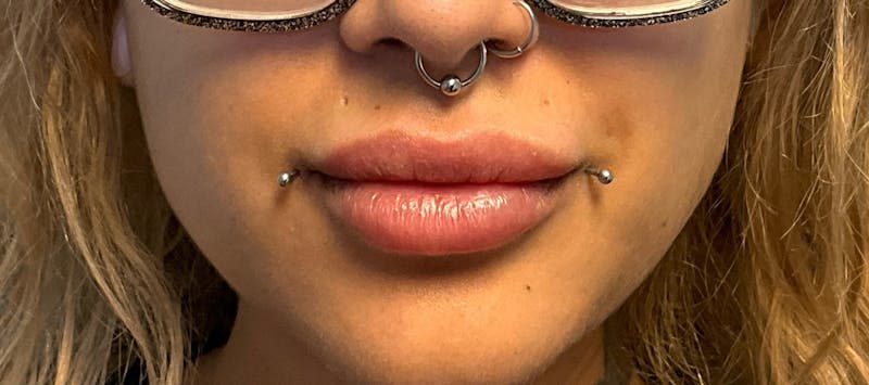 Fillers Before & After Gallery - Patient 369109 - Image 2