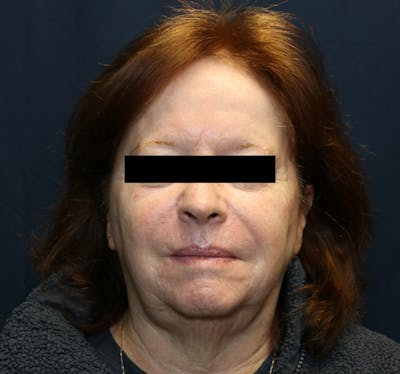 Halo Laser Before & After Gallery - Patient 421240 - Image 2