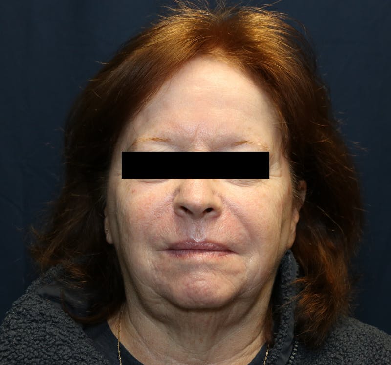 Halo Laser Before & After Gallery - Patient 421240 - Image 2
