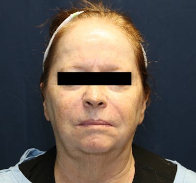 Halo Laser Before & After Gallery - Patient 421240 - Image 1