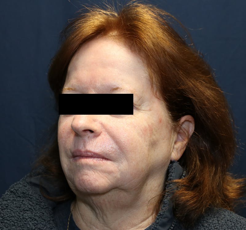 Halo Laser Before & After Gallery - Patient 421240 - Image 4