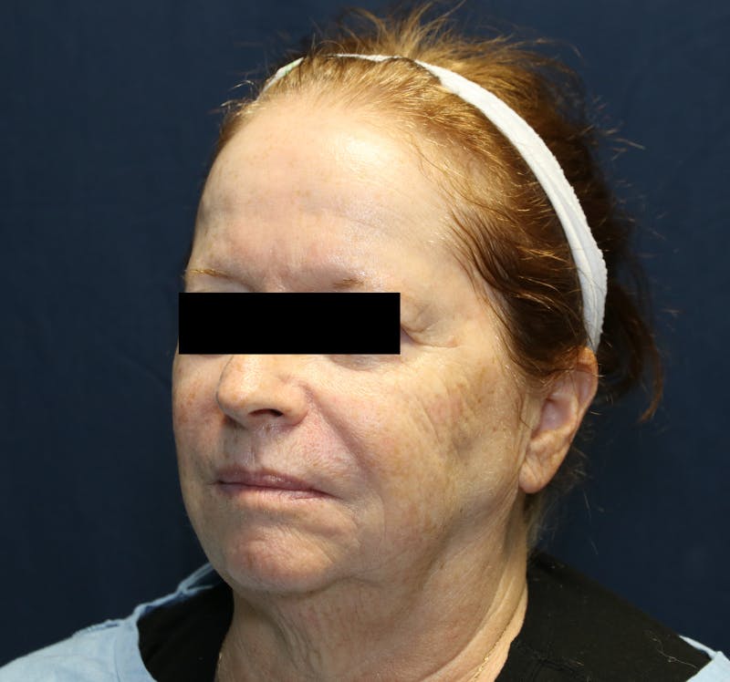 Halo Laser Before & After Gallery - Patient 421240 - Image 3