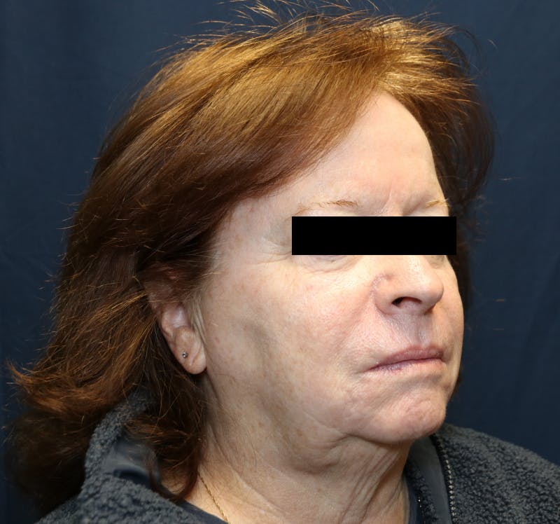 Halo Laser Before & After Gallery - Patient 421240 - Image 6