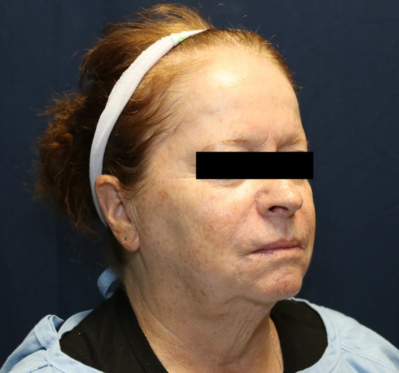 Halo Laser Before & After Gallery - Patient 421240 - Image 5