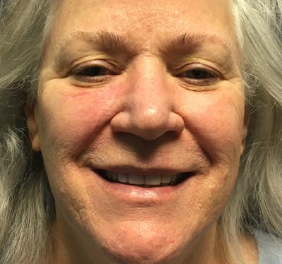 Red/Brown Spot Removal Before & After Gallery - Patient 755365 - Image 2