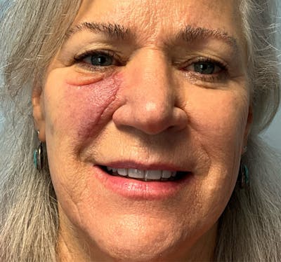 Red/Brown Spot Removal Before & After Gallery - Patient 755365 - Image 1