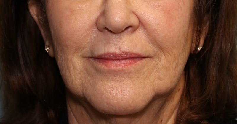 Skin Rejuvenation Before & After Gallery - Patient 427985 - Image 2