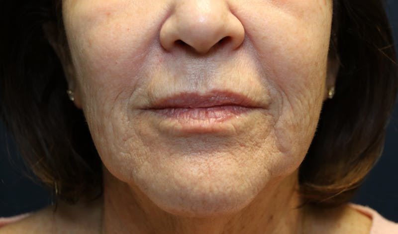 Skin Rejuvenation Before & After Gallery - Patient 427985 - Image 1