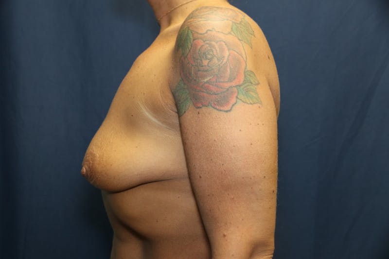 Augmentation (Enlargement) Before & After Gallery - Patient 181404 - Image 5
