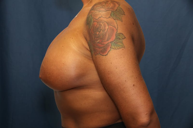Augmentation (Enlargement) Before & After Gallery - Patient 181404 - Image 6