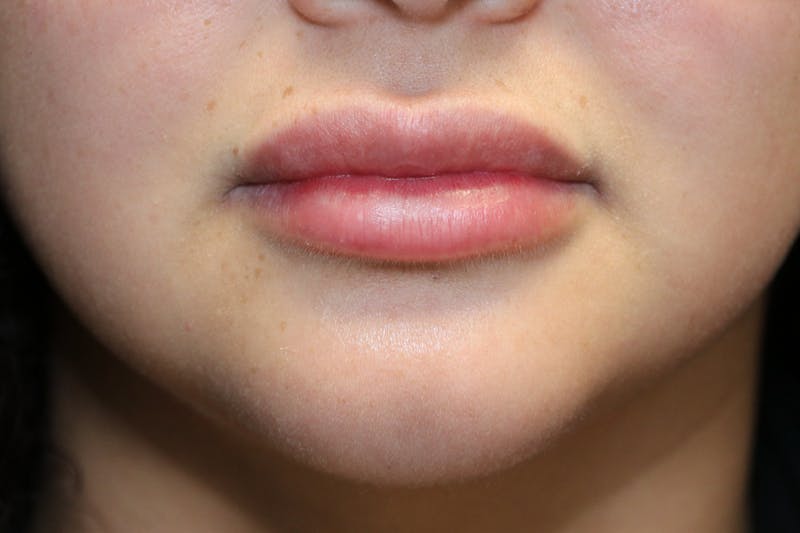 Fillers Before & After Gallery - Patient 279299 - Image 2