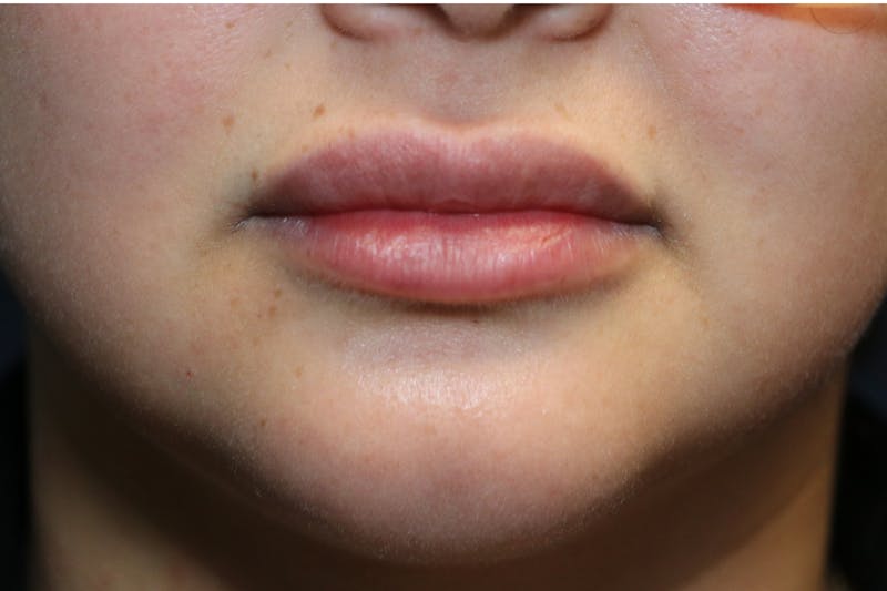 Fillers Before & After Gallery - Patient 279299 - Image 1