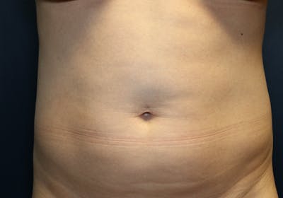 Liposuction Before & After Gallery - Patient 481624 - Image 1